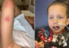 Mother Battles Hospital Dismissals as Son Suffers Severe Blisters