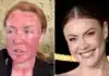 Camilla Kerslake’s Burnt Face After Painful CO2 Laser Treatment