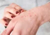 Harvest Mites in UK: What to Know About Itchy Bites