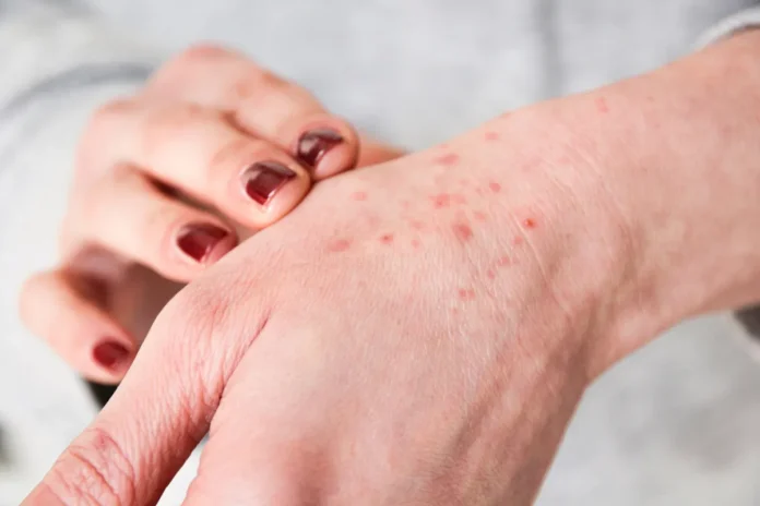 Harvest Mites in UK: What to Know About Itchy Bites Harvest Mites in UK: What to Know About Itchy Bites